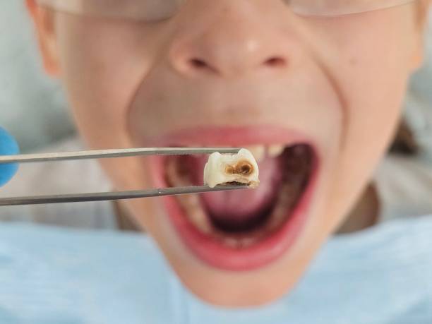 Best Emergency Broken Tooth Repair in Shrewsbury, MO